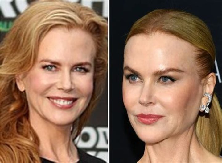 Unveiling The Transformation: Nicole Kidman Before And After Plastic Surgery Photos